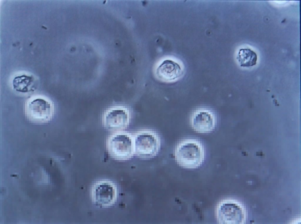 Microscope view of infected urine.