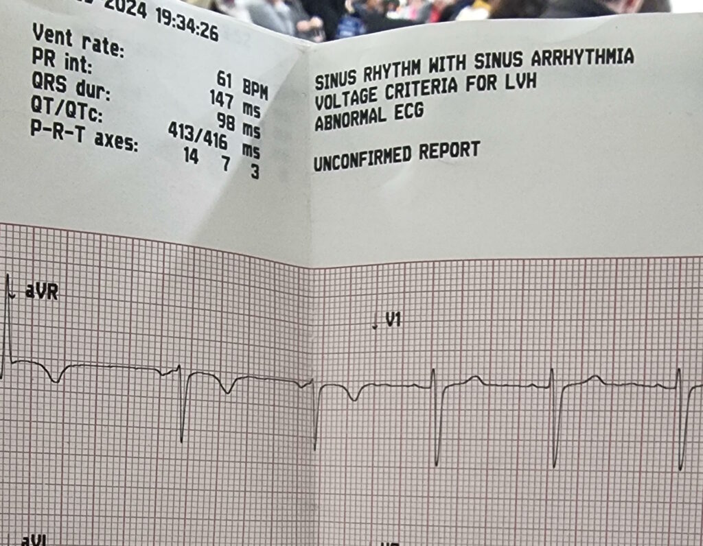 ECG printout showing a report of "Abnormal ECG: sinus arrhythmia".
